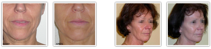 lifting visage