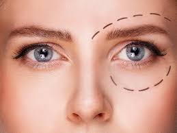 blepharoplastie-tunisie